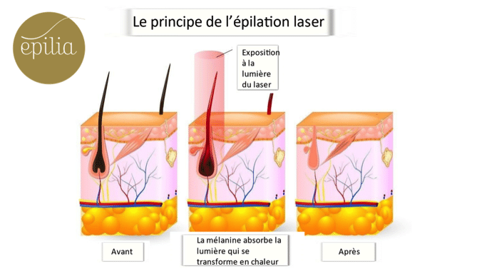 Quelle différence entre l'épilation à lumière pulsée et au laser